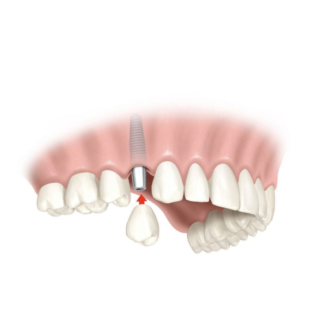 Implante Dental Unitario | Clínica Dental Doctores Gómez