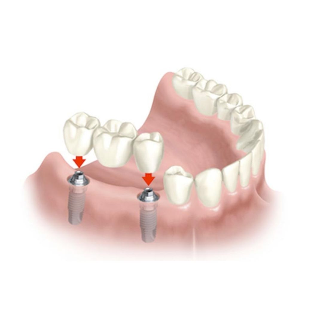 Puente Sobre Implantes | Clínica Dental Doctores Gómez