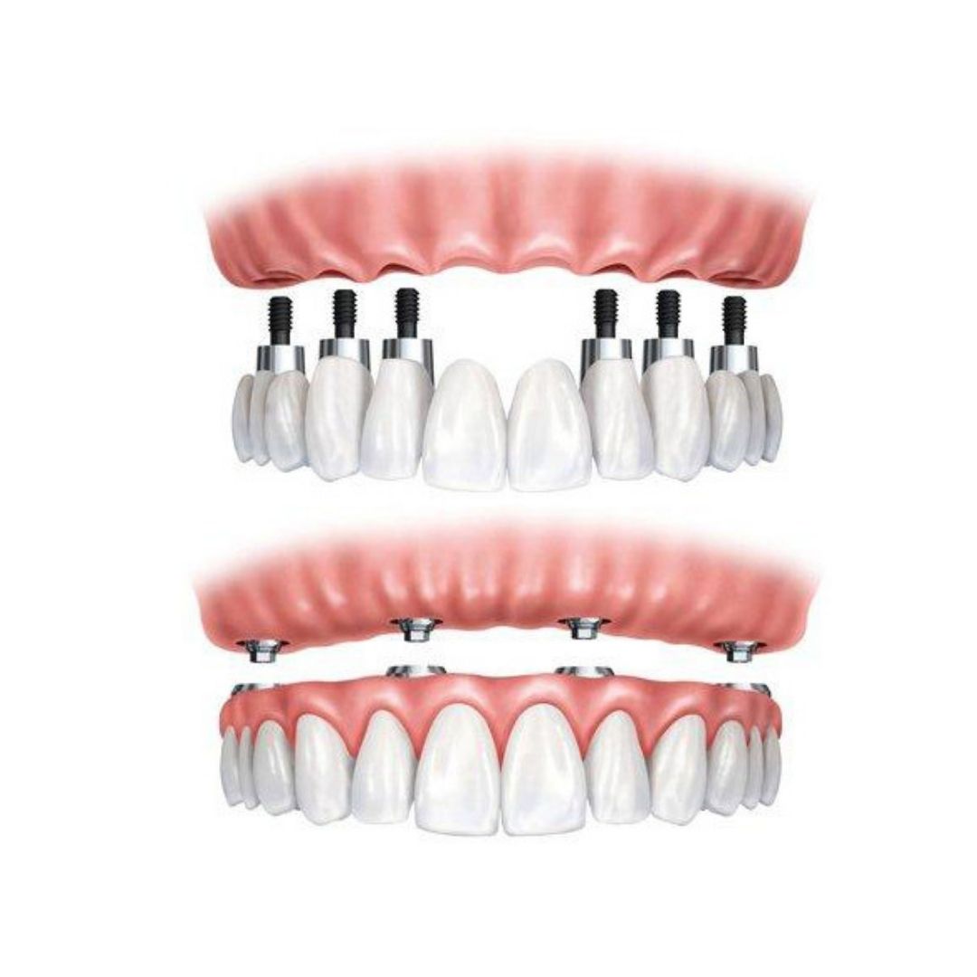 Sobredentadura - Híbrida Sobre Implantes | Clínica Dental Doctores Gómez