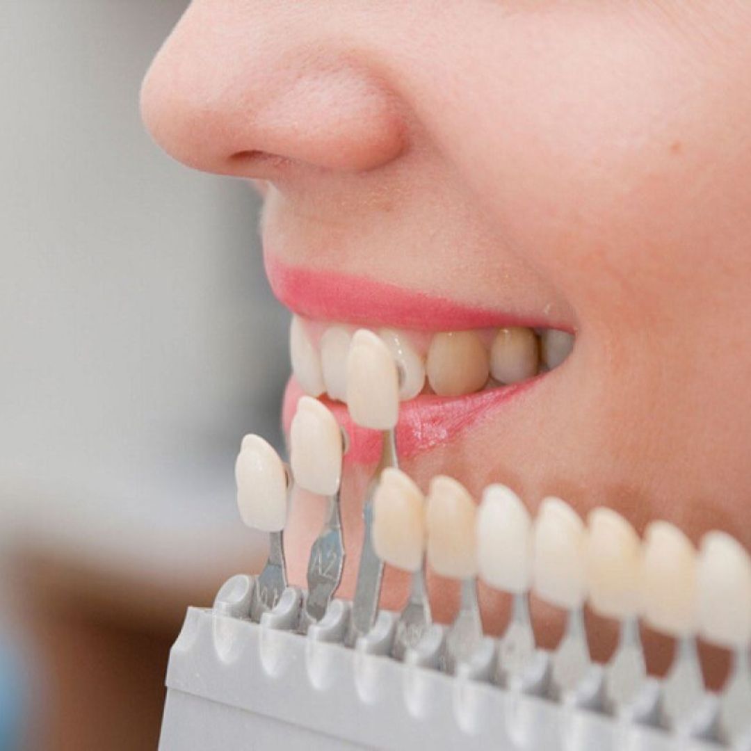 ¿Qué son las Carillas Dentales? - Caravaca de la Cruz | Clínica Dental Doctores Gómez